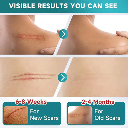 Silicone Scar Remover Tape for Acne & Wrinkles